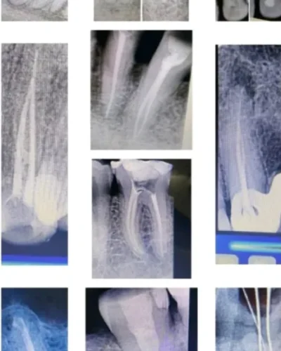 Root Canal Therapy